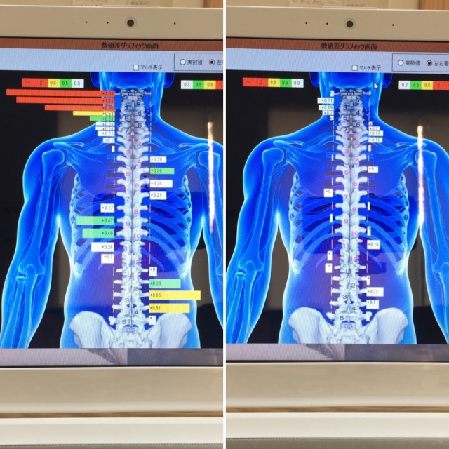 サーモグラフィー検査での「ビフォーアフターの一例」。柏市で整体なら宮田カイロプラクティックにお任せください。