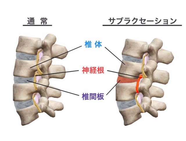 サブラクセーション画像。柏エリアでカイロプラクティックや整体院をお探しなら宮田カイロプラクティック整体院！