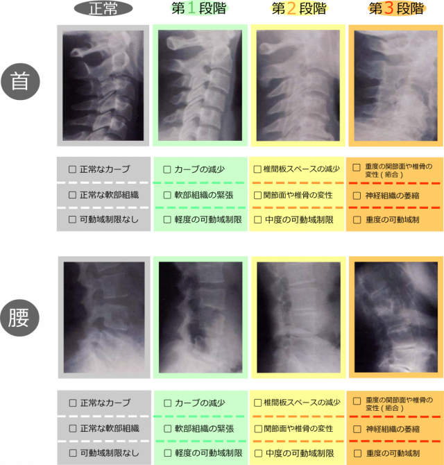 椎間板の団塊と改善　画像