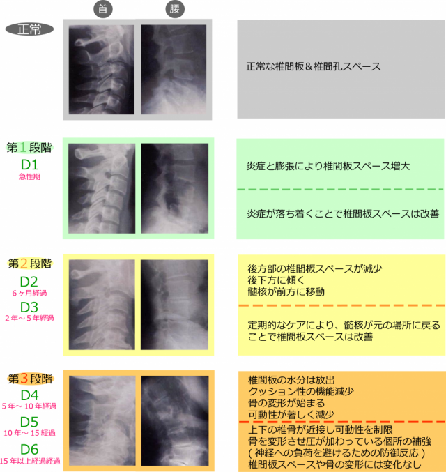 椎間板の段階と改善　画像