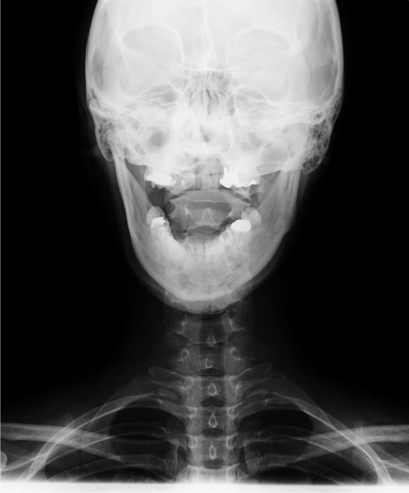 頸椎の正面像
