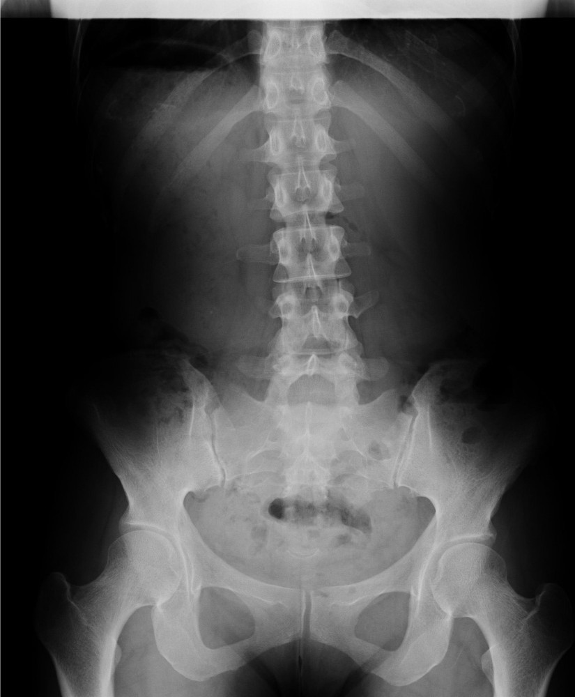 骨盤と腰椎の正面像