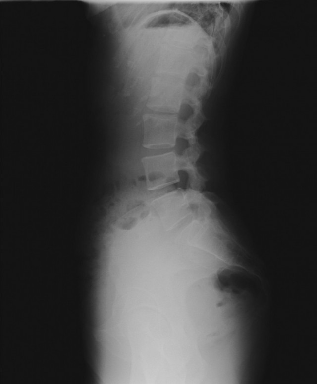 骨盤と腰椎の側面像
